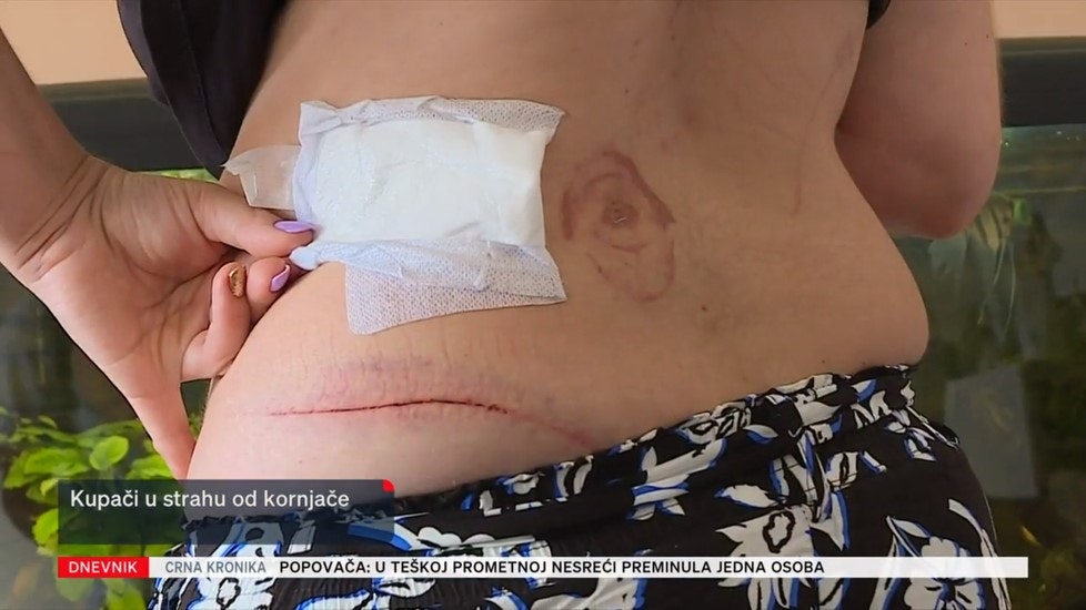 Vėžlio įkandimas ir įbrėžimas ant turisto nugaros. Nuotraukų šaltinis: Šaltinis: Dnevnik Nove TV, Kroatija