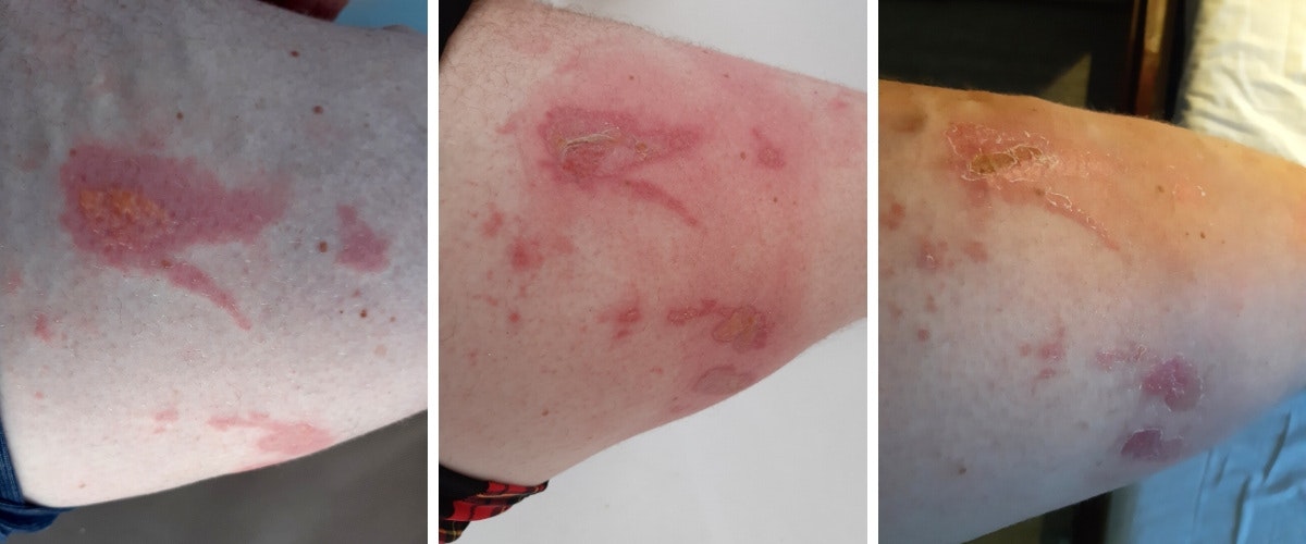 Quallen (von links) 1. Frische Verletzung, 2. sekundäre Flüssigkeitsblasenbildung, und 3. Zustand nach einer Woche 